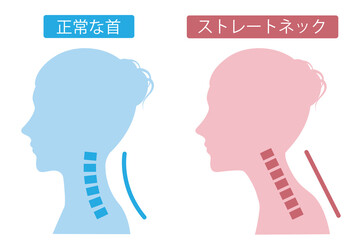 ストレートネックの女性　シルエット　ビフォアアフター
