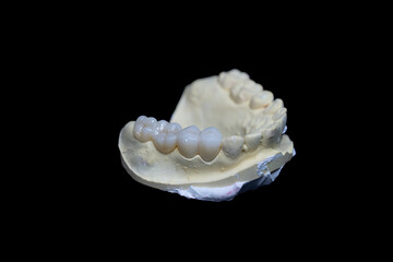 Upper jaw tooth model made of yellow dental stone. In the left region, there are premolar and molar zirconia dentures. © Johanes