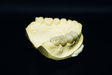 Upper jaw tooth model made of yellow dental stone. In the left region, there are premolar and molar zirconia dentures. © Johanes