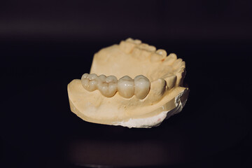 Upper jaw tooth model made of yellow dental stone. In the left region, there are premolar and molar zirconia dentures. © Johanes