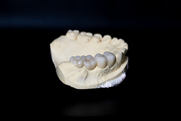 Upper jaw tooth model made of yellow dental stone. In the left region, there are premolar and molar zirconia dentures. © Johanes