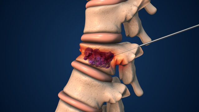 Vertebral Fracture Fixation with Medical Cement or Vertebroplasty