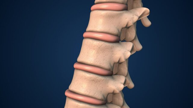 Vertebral Fracture Fixation with Medical Cement or Vertebroplasty
