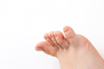 Obraz premium Stages of a Wart Falling Off, Skin Changes, human foot with wart after nitrogen treatment on toe on white background. Suitable for medical research, pharmaceutical companies, and healthcare education