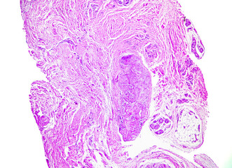 Male, 35 years old, gout, pathological section of left thumb. Gout nodules are composed of acellular, amorphous and weakly eosinophilic substances, showing a granulomatous appearance. Magnify 40x.