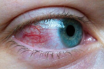 Side view of blood vessels in the human eye, featuring a blue iris and eyelashes.