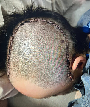 Craniectomy after brain surgery in hospital. 