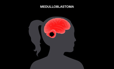 Medulloblastoma brain cancer