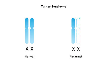 Turner Syndrome Science Design. Vector Illustration.