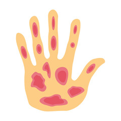 Obraz premium Kaposi sarcoma