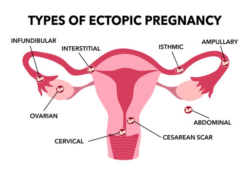 Ectopic Pregnancy. Types of Tubal pregnancy, ovarian, abdominal, cervical pregnancy. medical diagram with female reproductive system and various embryo attachment locations.