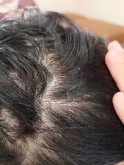 dandruff on hair that rarely uses shampoo