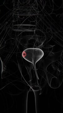 Close up of Bladder Cancer indication in Female X-ray Vertical HQ Video | Bladder Cancer indication X-ray HQ Vertical