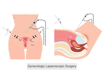 Gynecologic Laparoscopic Surgery is a minimally invasive surgical procedure.