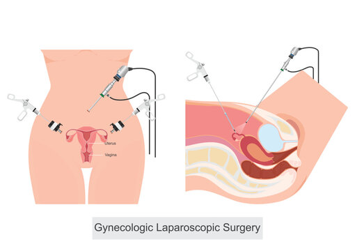 Gynecologic Laparoscopic Surgery is a minimally invasive surgical procedure.