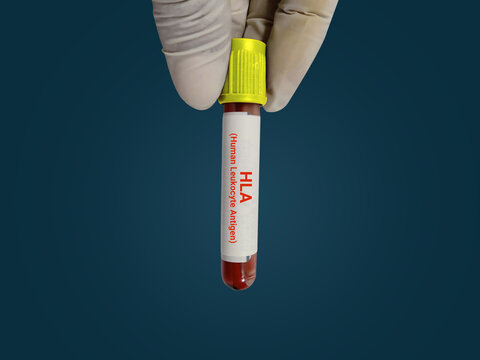 Scientist hold blood sample test tube for HLA (Human Leukocyte Antigen) Test with laboratory background. Healthcare and medical test concept.
