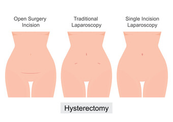 A Hysterectomy is a surgical removal of the uterus.