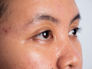close up of the face of an Asian woman who has facial problems due to acne and air pollution. Close up of asian woman's eyes.