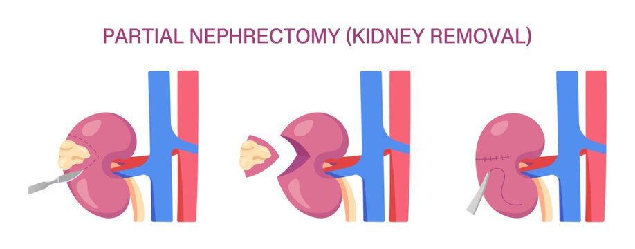 Partial Nephrectomy Surgery. Partial Nephrectomy Kidney Removal. Cross Section. Vector medical illustration of kidney removal procedure with incision, resection, and suturing.