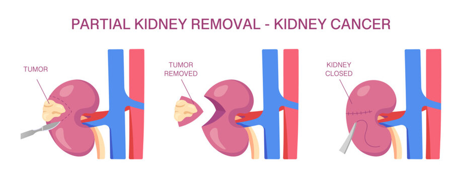 Partial Kidney Removal for Cancer. Vector medical illustration of nephrectomy surgery with tumor removal and suturing. Cross Section. 3D Illustration.