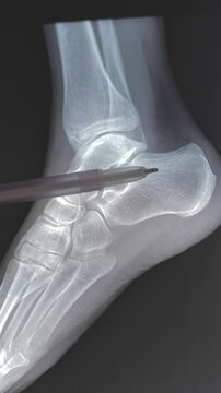 Close up, Vertical x-ray of a normal healthy heel bone. 4k video.