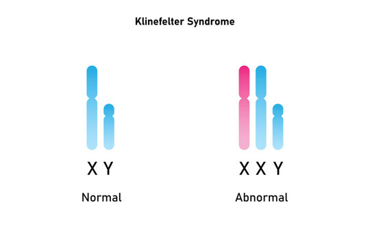 Klinefelter Syndrome Science Design. Vector Illustration.