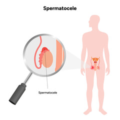 Spermatocele Testicular disease. Man reproductive health system pain testicle pathology problem. Medical diagram 