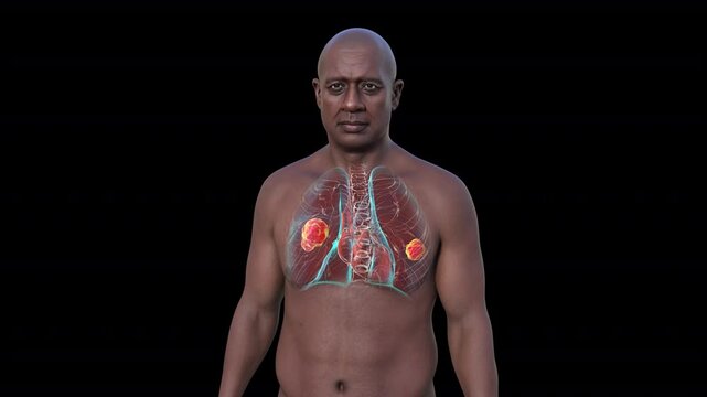 Lung mucormycosis, 3D animation showing fungal infection caused by Mucorales fungi, highlighting multiple irregular lung nodules.