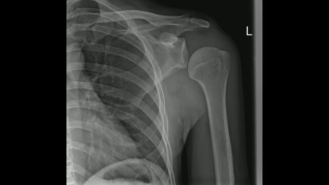 AP Shoulder Joint X-ray Detail