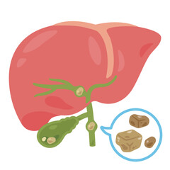 結石ができた胆嚢と肝臓のイラスト1