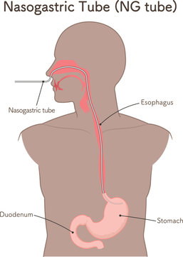 胃ドレナージ、Nasogastric tube