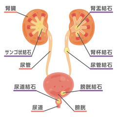 結石ができた腎臓と膀胱のイラスト1