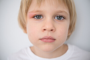 close up little boy with allergic red spot at eye cause by mosquito bite
