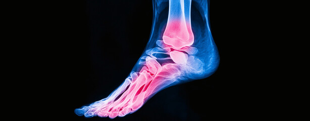Artificial intelligence in medical detection. X ray image of foot showing injury detection with highlighted areas