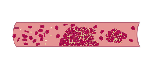 Medical histological chart of thromboembolism in an artery.