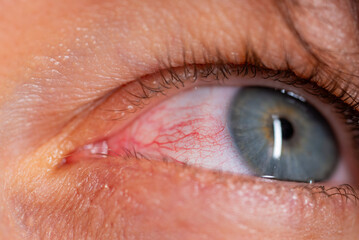 Blood vessels are clearly visible in the irritated eye, highlighting the discomfort and...