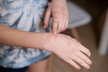 Fototapeta premium Cold dermatitis on a child's arm. How to treat peeling on your hands during the cold season. Close-up.