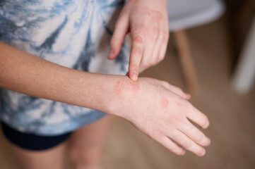 Fototapeta premium Cold dermatitis on a child's arm. How to treat peeling on your hands during the cold season. Close-up.