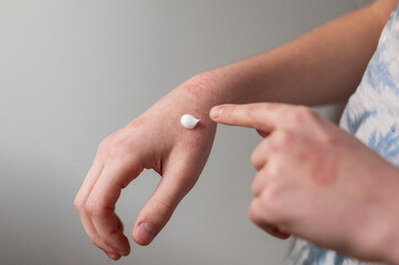 The child smears his hand with a moisturizer, Cold dermatitis on a child's arm.