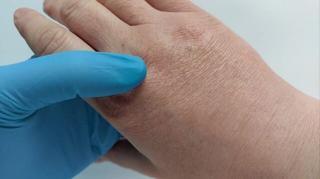 Medical Professional Consulting with a Patient About Dry, Cracked Hands, Possibly Caused by Cold Weather or Allergies. Doctors Examination. Assessing Reddened, Flaky Skin with Deep Cracks
