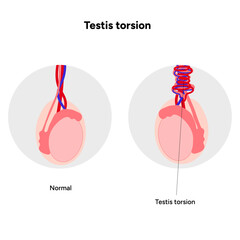 Testis torsion Testicular disease. Man reproductive health system pain testicle pathology problem. Medical diagram  © Oksana