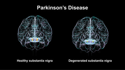 Subtantia nigra in healthy brain and Parkinson disease, 3D illustration