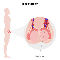 Testis torsion Testicular disease. Man reproductive health system pain testicle pathology problem. Medical diagram 