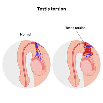 Testis torsion Testicular disease. Man reproductive health system pain testicle pathology problem. Medical diagram 