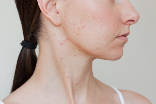 Young pretty brunette caucasian woman demonstrating the pimples on her cheek and neck close up, experiencing discomfort, suffering from a skin disease on her face-rosacea in the acute stage and acne