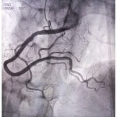 Coronary angiogram of right coronary artery during cardiac catheterization with dye. Findings...