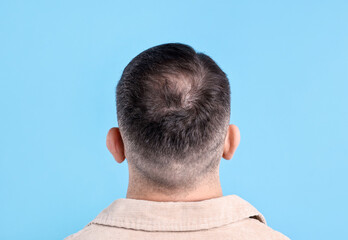 Obraz premium Baldness problem. Man with bald spot on light blue background, back view