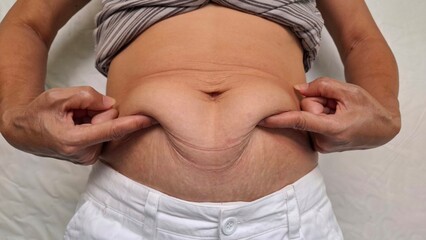 Middle-aged woman with a saggy, wrinkled belly and stretch marks