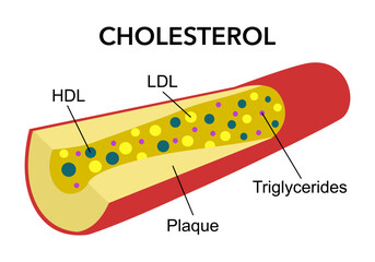 Cholesterol in blood vessel in flat design. HDL, LDL, triglycerides.