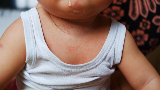 Severe prickly heat on the baby's neck.